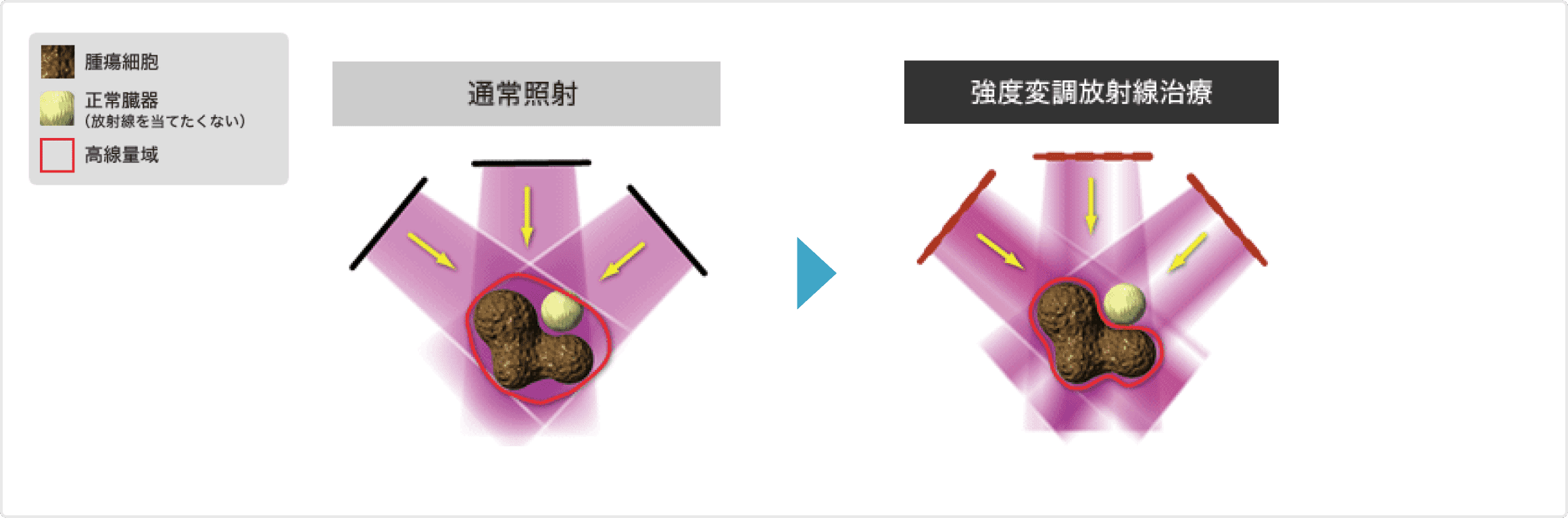 強度変調放射線治療の説明図